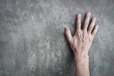 Asyalı yaşlı adamın elindeki yaş lekeleri. Bunlar kahverengi, gri veya siyah noktalardır ve ayrıca karaciğer lekeleri, bunak mercimek, güneş mercimeği veya güneş lekeleri olarak da adlandırılır..