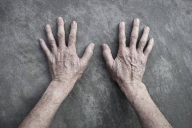 Asyalı yaşlı adamın ellerinde yaş lekeleri var. Bunlar kahverengi, gri veya siyah noktalardır ve ayrıca karaciğer lekeleri, bunak mercimek, güneş mercimeği veya güneş lekeleri olarak da adlandırılır..