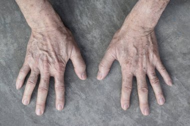 Asyalı yaşlı adamın ellerinde yaş lekeleri var. Bunlar kahverengi, gri veya siyah noktalardır ve ayrıca karaciğer lekeleri, bunak mercimek, güneş mercimeği veya güneş lekeleri olarak da adlandırılır..