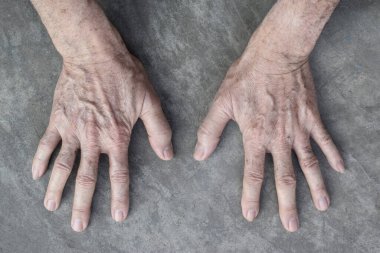 Age spots on hands of Asian elder man. They are brown, gray, or black spots and also called liver spots, senile lentigo, solar lentigines, or sun spots. clipart