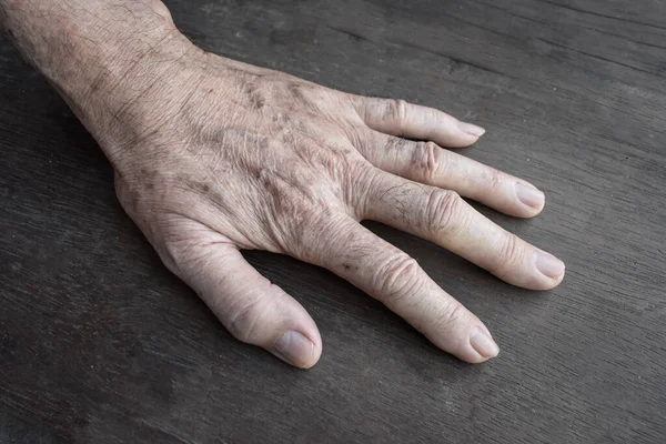 Manchas Idade Mão Homem Mais Velho Asiático São Manchas Castanhas — Fotografia de Stock