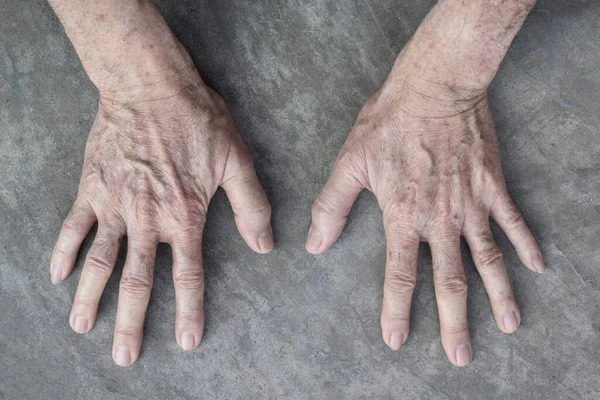 Altersflecken Auf Den Händen Eines Asiatischen Älteren Mannes Sie Sind — Stockfoto
