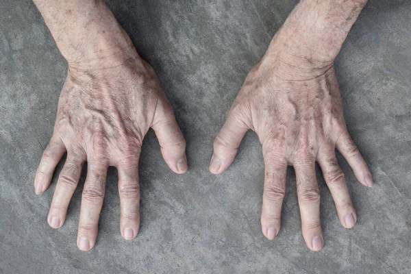 Des Taches Vieillesse Sur Les Mains Aîné Asiatique Sont Des — Photo