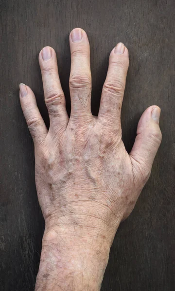 Altersflecken Der Hand Eines Asiatischen Älteren Mannes Sie Sind Braune — Stockfoto