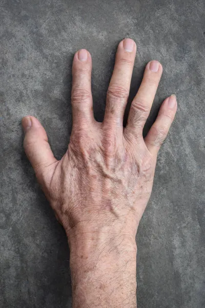 Altersflecken Der Hand Eines Asiatischen Älteren Mannes Sie Sind Braune — Stockfoto