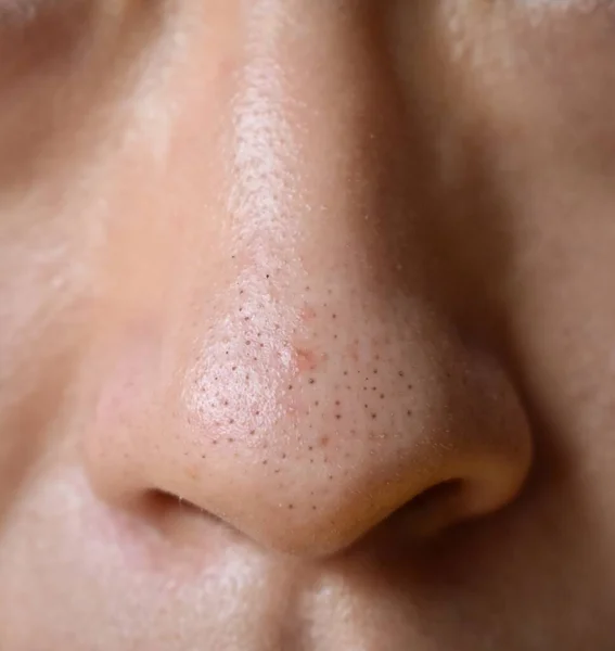 Blackheads Cabeças Pretas Nariz Homem Asiático Eles São Pequenos Solavancos — Fotografia de Stock