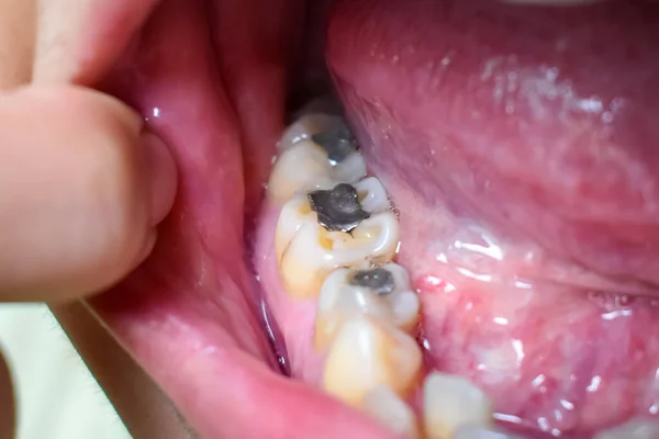 Silver amalgam fillings at right lower first molar and left lower second premolar teeth in Asian, young man. Dental caries are also present showing poor oral hygiene.