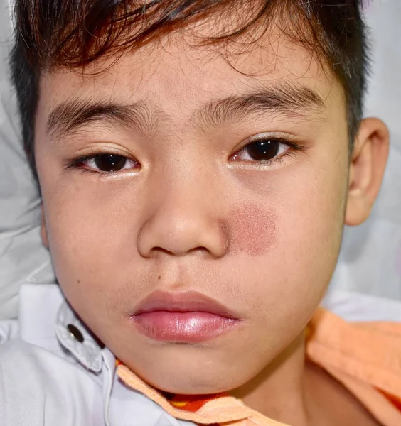 Tinea faciei or Fungal Infection on face of Southeast Asian, Burmese two years old Child