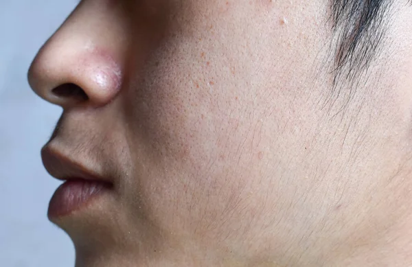 Fair skin with wide pores in hairy face of Southeast Asian, Myanmar or Korean adult young man.