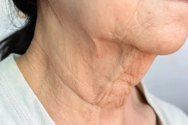 Aging skin folds or skin creases or wrinkles at neck of Southeast Asian, Chinese old woman.