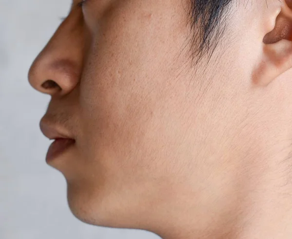 Fair skin with wide pores in hairy face of Southeast Asian, Myanmar or Korean adult young man.