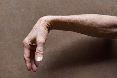 Radial nerve injury or wrist drop of Asian old man. clipart