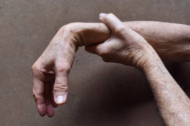 Radyal sinir hasarı ya da Asyalı ihtiyarın bilek damlası..