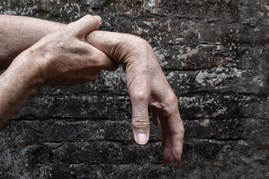 Radyal sinir hasarı ya da Asyalı ihtiyarın bilek damlası..