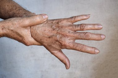 Asyalı yaşlı adamın ellerinde yaş lekeleri var. Bunlar kahverengi, gri veya siyah noktalardır ve ayrıca karaciğer lekeleri, bunak mercimek, güneş mercimeği veya güneş lekeleri olarak da adlandırılır..