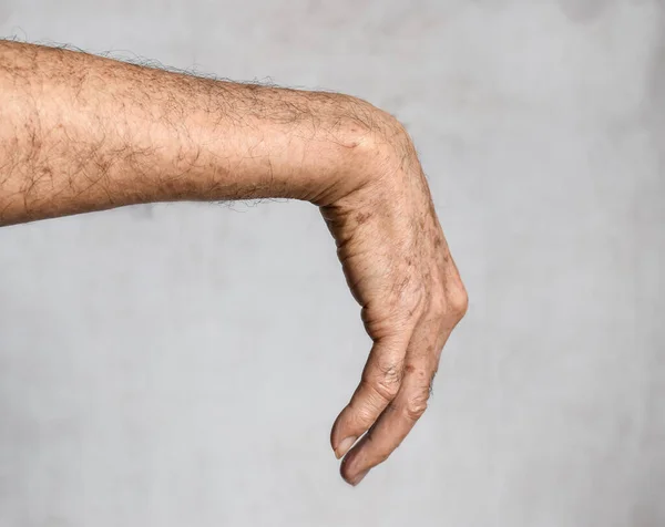 Verletzung Des Radialnervs Oder Des Handgelenks Des Asiatischen Älteren Mannes — Stockfoto