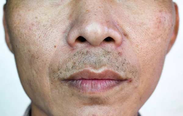 Drsná Kůže Tváří Tvář Jihovýchodní Asii Myanmaru Nebo Korejskému Dospělému — Stock fotografie