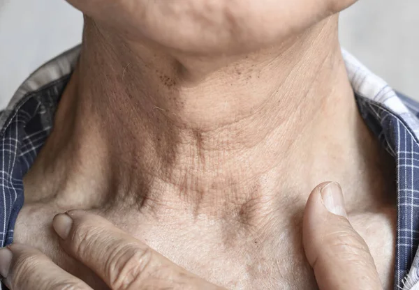 Γήρανση Του Δέρματος Πτυχώσεις Ρυτίδες Του Δέρματος Στο Λαιμό Της — Φωτογραφία Αρχείου