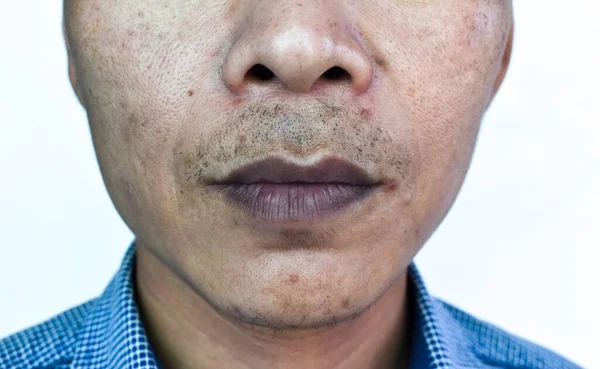Bibir Sianotik Atau Pusat Sianosis Pada Pria Asia Tenggara Dengan — Stok Foto