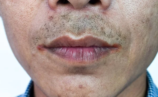 Angular Stomatitis Atau Angular Cheilitis Atau Perleche Pada Manusia Beralkohol — Stok Foto