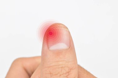 Inflammation at the tip of fingernail. Concept of paronychia at thumb of Asian young man. Painful finger. clipart