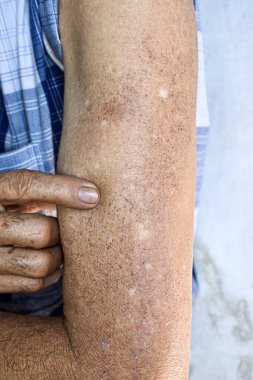 Age spots and white patches on arm of Asian elder man. Age spots are brown, gray, or black spots and also called liver spots, senile lentigo, solar lentigines, or sun spots. clipart