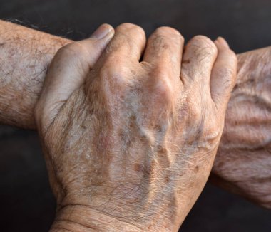 Age spots on hands of Asian elder man. They are brown, gray, or black spots and also called liver spots, senile lentigo, solar lentigines, or sun spots. Concept of rheumatoid arthritis , osteoarthritis, wrist strain or joint pain. clipart