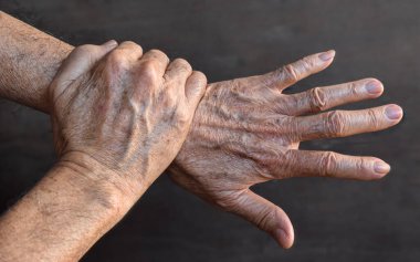 Asyalı yaşlı adamın ellerinde yaş lekeleri var. Bunlar kahverengi, gri veya siyah noktalardır ve ayrıca karaciğer lekeleri, bunak mercimek, güneş mercimeği veya güneş lekeleri olarak da adlandırılır. Romatoid eklem iltihabı, osteoartrit, bilek zorlanması veya eklem ağrısı kavramı.