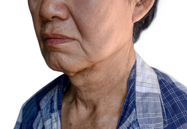 Γήρανση Του Δέρματος Πτυχώσεις Ρυτίδες Του Δέρματος Της Νοτιοανατολικής Ασίας — Φωτογραφία Αρχείου
