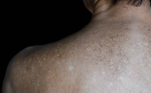 Age spots and white patches on upper back of Asian elder man. Age spots are brown, gray, or black spots and also called liver spots, senile lentigo, solar lentigines, or sun spots.