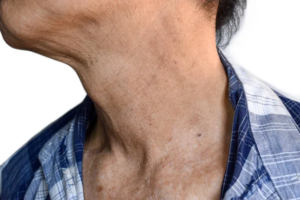 Aging Skin Folds Skin Creases Wrinkles Neck Southeast Asian Chinese — Stock Photo, Image