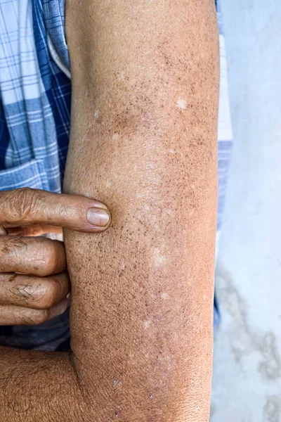 Age spots and white patches on arm of Asian elder man. Age spots are brown, gray, or black spots and also called liver spots, senile lentigo, solar lentigines, or sun spots.