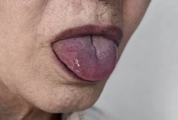 Labios Cianóticos Cianosis Central Hombre Anciano Del Sudeste Asiático Con —  Fotos de Stock