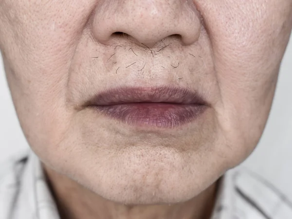 Κυανοτικά Χείλη Κεντρική Κυάνωση Ηλικιωμένο Άνδρα Της Νοτιοανατολικής Ασίας Συγγενή — Φωτογραφία Αρχείου