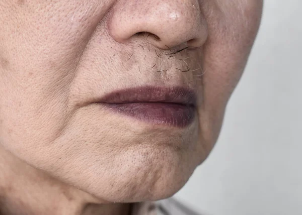 Κυανοτικά Χείλη Κεντρική Κυάνωση Ηλικιωμένο Άνδρα Της Νοτιοανατολικής Ασίας Συγγενή — Φωτογραφία Αρχείου