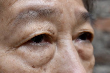 Prominent fat bag under eye of Asian elder woman. Closeup view. clipart