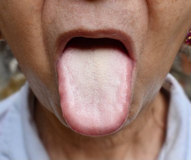 Asyalı ya da Çinli bir kadının beyaz dili. Enkaz, bakteri ve ölü hücreler büyüyen papillae arasında kaldığında beyaz tabakada görülür. Ageusia denilen tat kaybı..