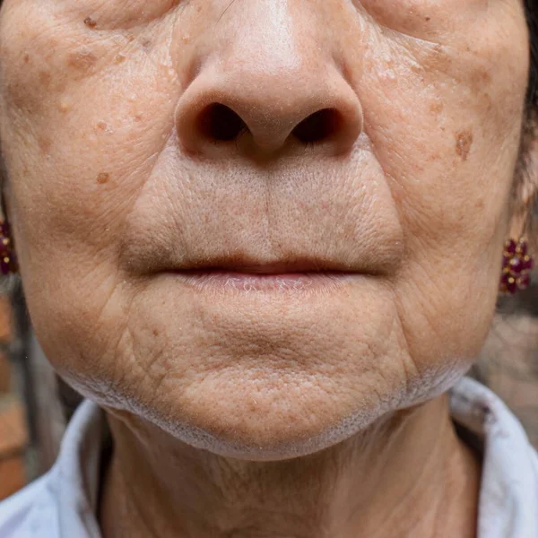 Envelhecimento Dobras Pele Vincos Pele Rugas Face Sudeste Asiático Mulher — Fotografia de Stock