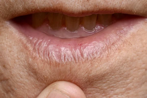 Chapped Χείλη Που Ονομάζεται Χειλίτιδα Στην Ασιατική Ηλικιωμένη Γυναίκα — Φωτογραφία Αρχείου