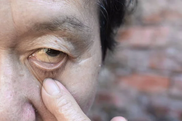 Pale Skin Asian Elderly Man Sign Anemia Pallor Eyelid — Stock Photo, Image