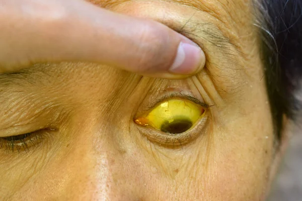 Deep Jaundice Asian Male Patient Yellowish Discoloration Skin Sclera Hyperbilirubinemia — Stock Photo, Image