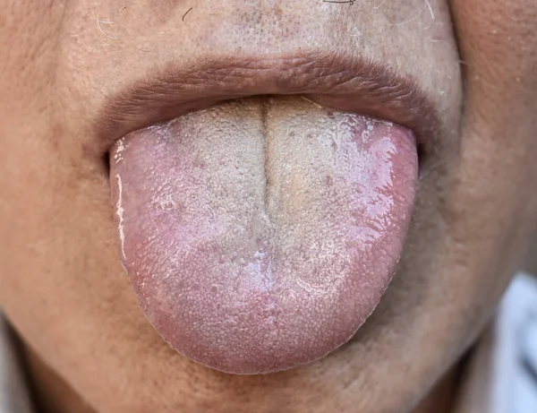 Fissured Tongue Southeast Asian Elder Man Marked Deep Prominent Groove — Stock Photo, Image