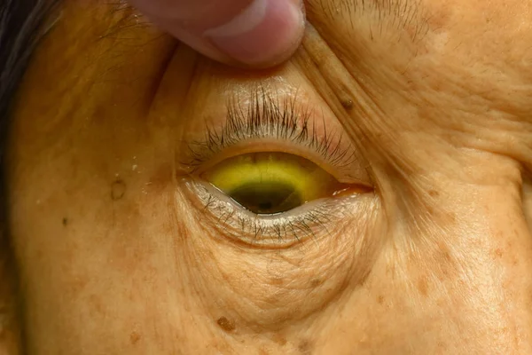 Deep Jaundice Asian Female Patient Yellowish Discoloration Skin Sclera Hyperbilirubinemia — Stock Photo, Image