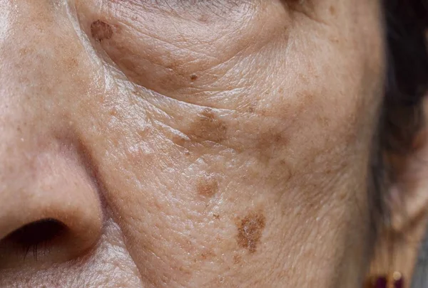 Small brown patches called age spots on face of Asian elder woman. They are also called liver spots, senile lentigo, or sun spots. Closeup view.