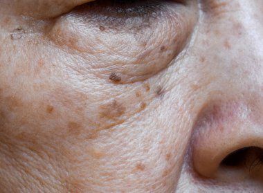 Small brown patches called age spots on face of Asian elder woman. They are also called liver spots, senile lentigo, or sun spots. Closeup view. clipart