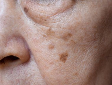 Small brown patches called age spots on face of Asian elder woman. They are also called liver spots, senile lentigo, or sun spots. Closeup view. clipart