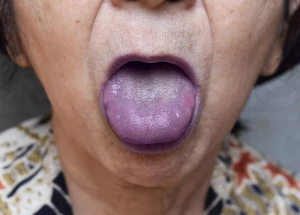 Labios Cianóticos Cianosis Central Sudeste Asiático Anciana China —  Fotos de Stock