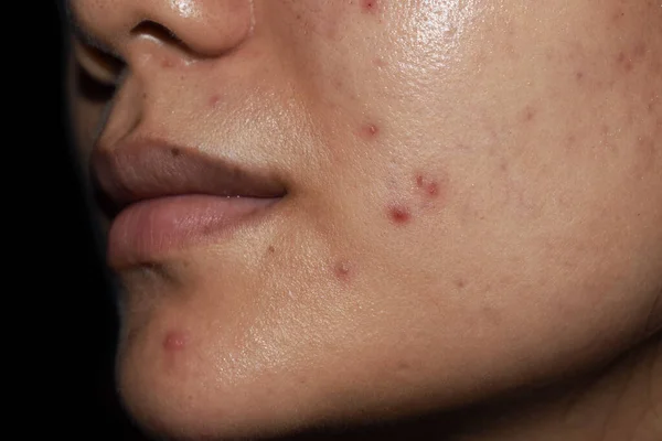 Acne Macchie Rosse Cicatrici Sul Viso Della Giovane Donna Asiatica — Foto Stock