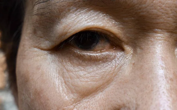 Tas Gemuk Dan Keriput Menonjol Bawah Mata Orang Tua Asia — Stok Foto