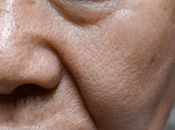 Enlarged Pores Face Southeast Asian Chinese Elder Man — Stock Photo, Image